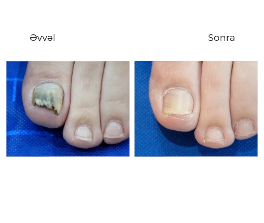 Candela GentleMax Pro Plus